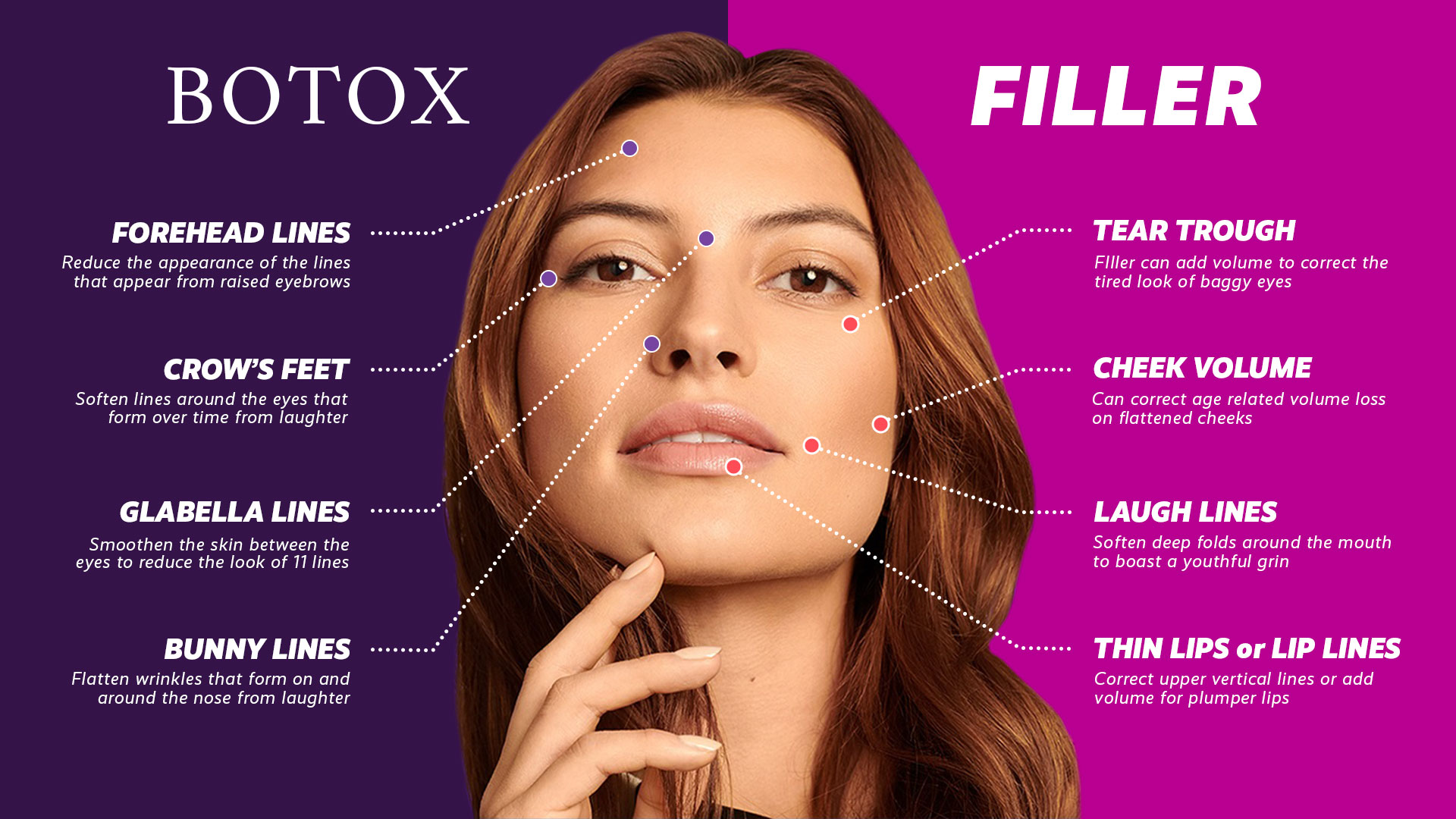 Botox and Fillers